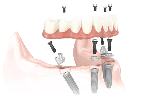 best dental implant center fro all four dental implants