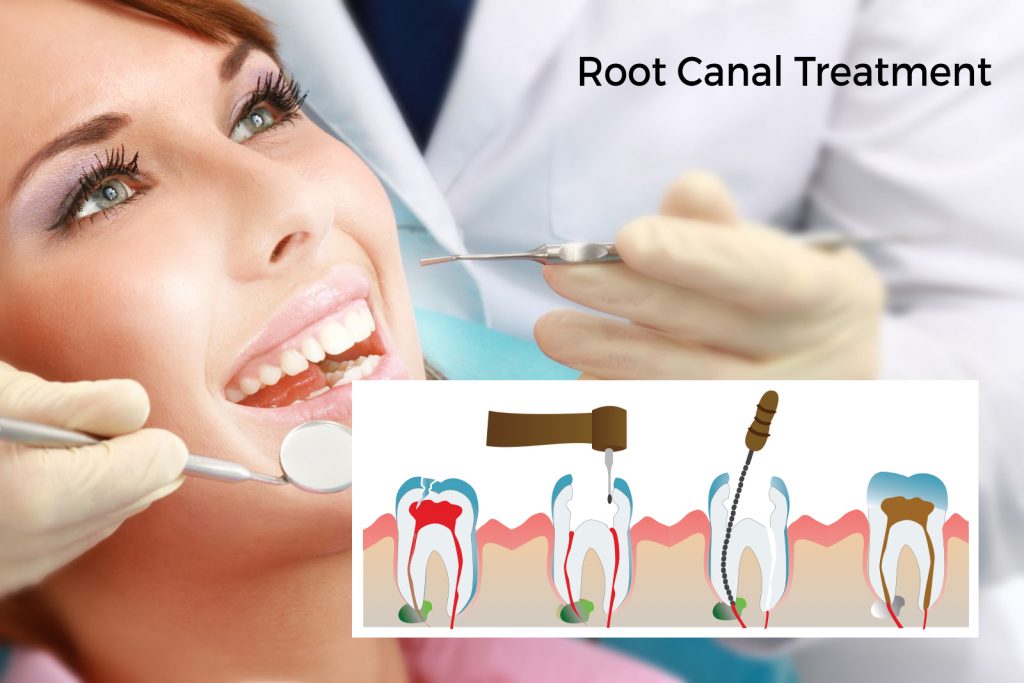 single sitting root canal treatment