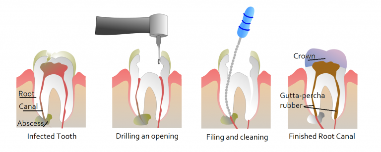 root canal treatment cost in vijayawada