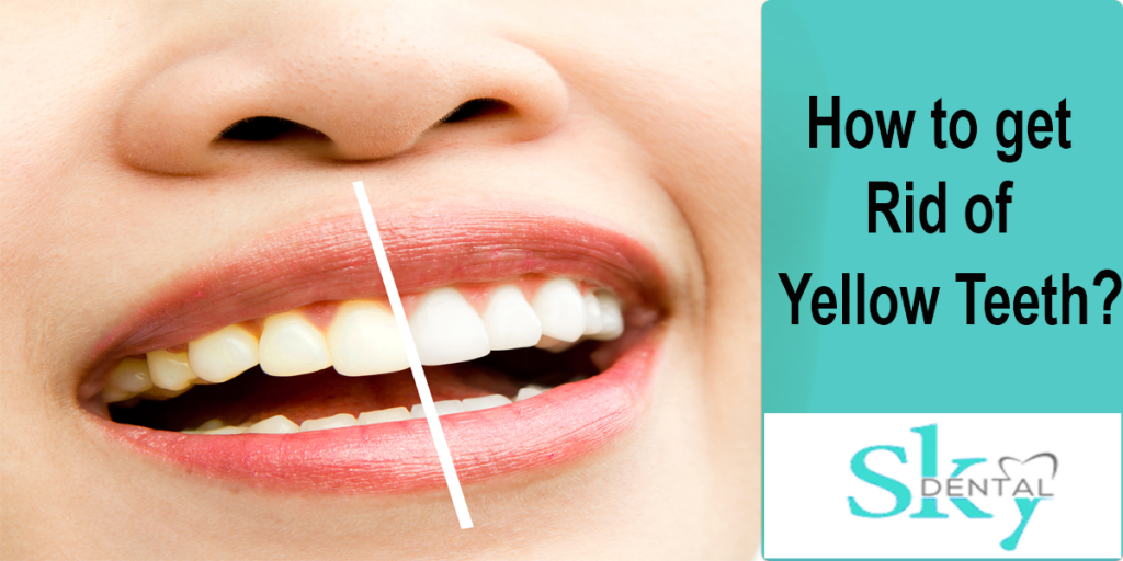 importance of Tooth Whitening