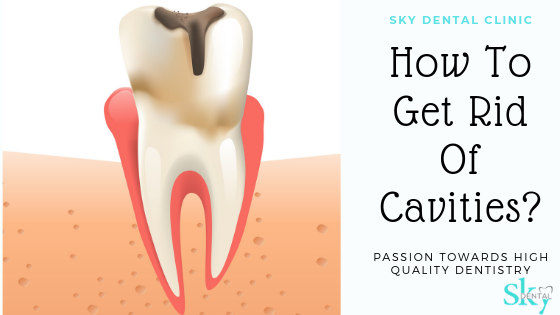 How To Get Rid Of Cavities?