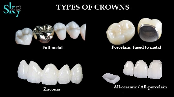 types of crowns