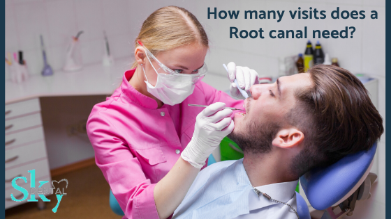 How many visits does a root canal need?