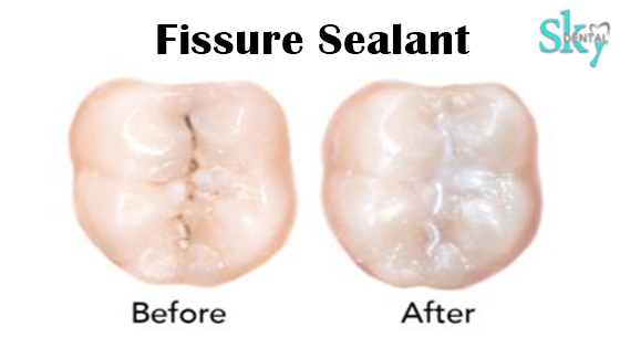 Dental Sealant