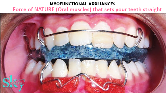 Myofunctional Appliances