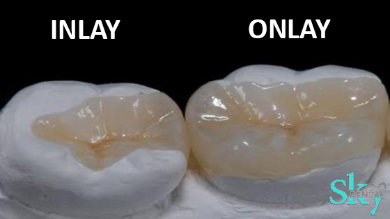 Inlays and Onlays