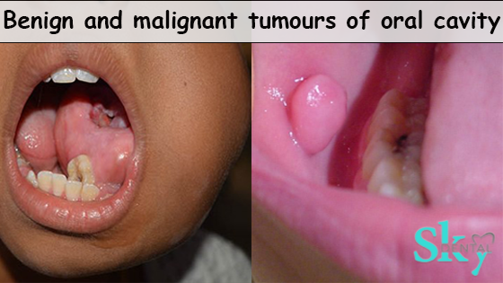 Benign and Malignant Tumours