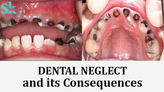 Dental neglect and its consequences