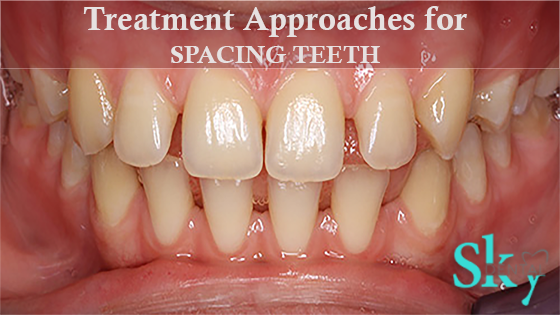 Treatment Approaches for spacing teeth