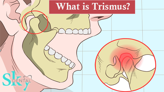 TRISMUS