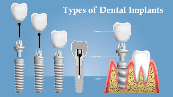 Types of Dental Implants