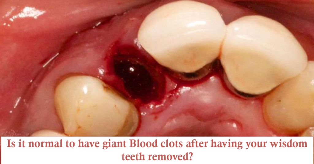 Blood clots