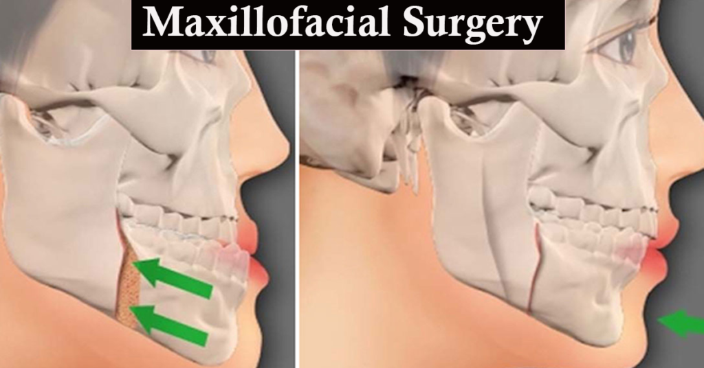 Maxillofacial Surgery