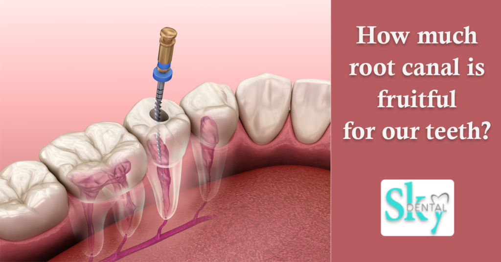 How much root canal is fruitful for our teeth?