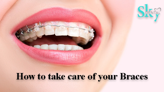 How to take care of your Braces