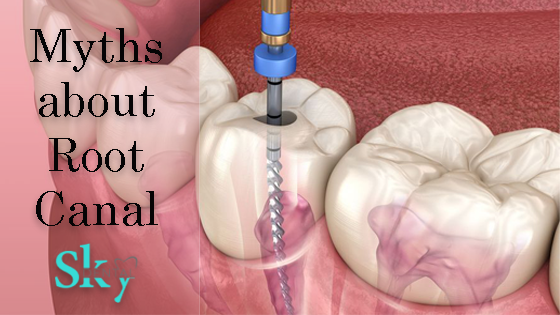 Myths about root canal