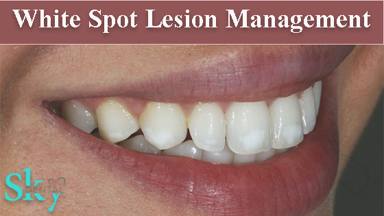 Management of white spot lesions