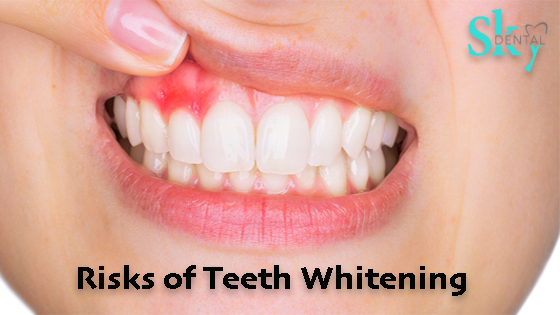 risks you need to know about teeth whitening