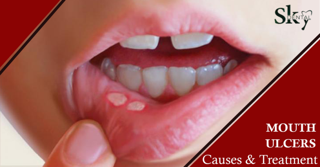 Mouth Ulcers