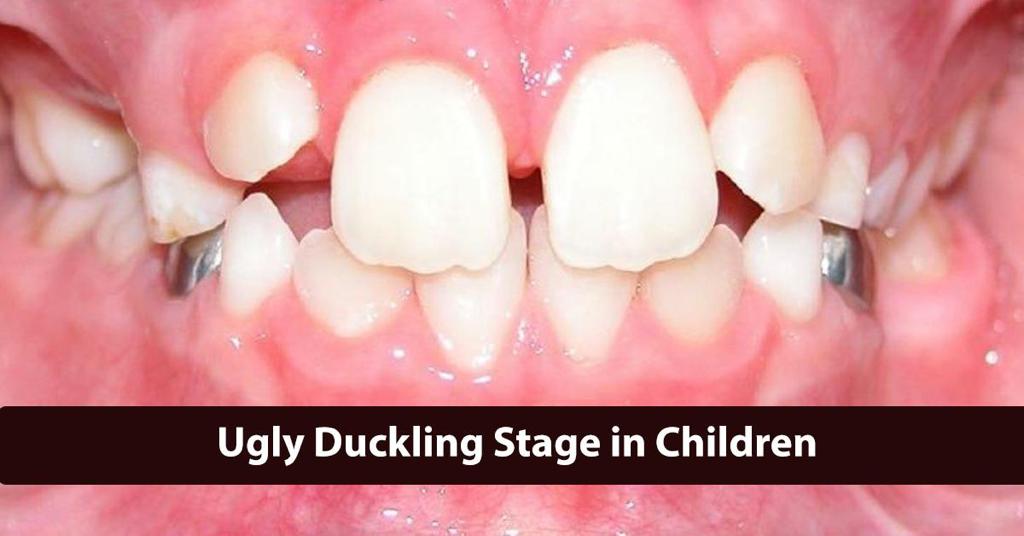 Ugly Duckling stage in Children