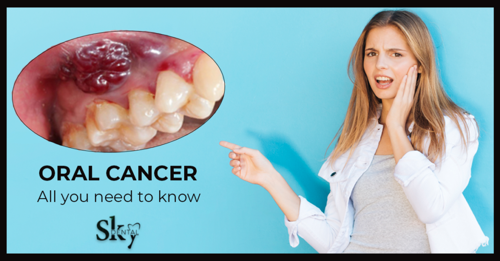 oral cancer