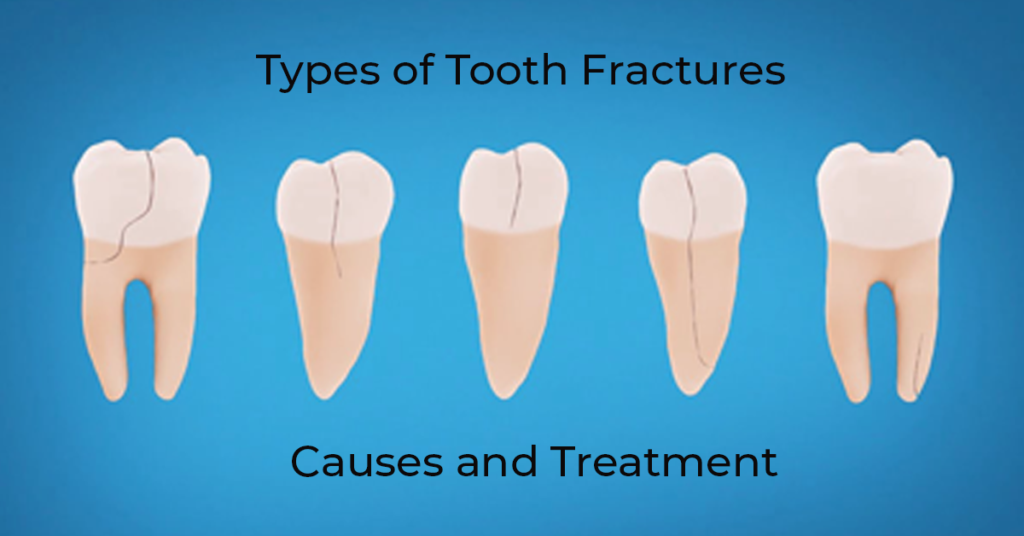 tooth fracture