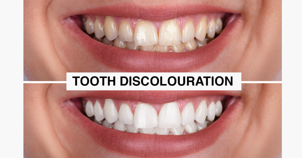 Tooth discolouration