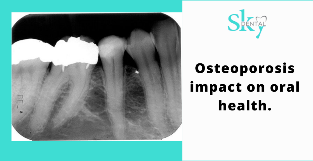 Osteoporosis impact on oral health