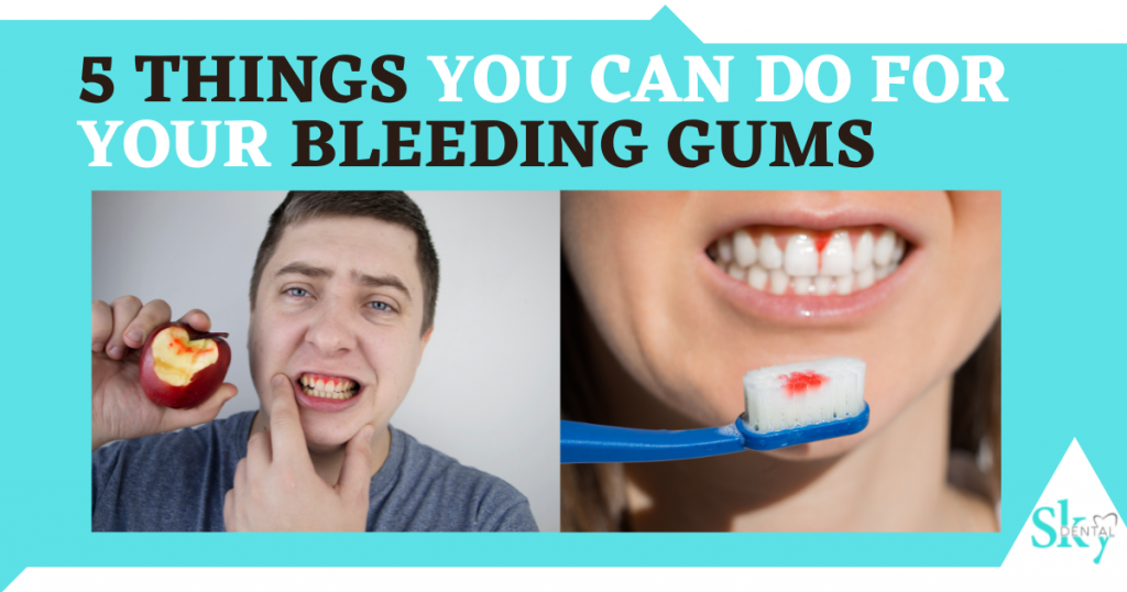 5 things you can do for your gums bleeding