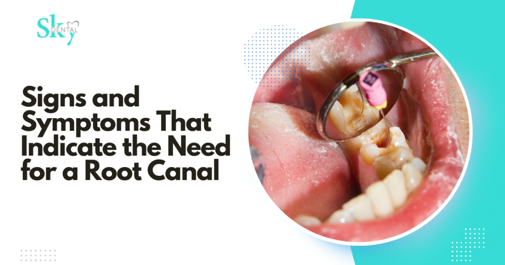 Signs and Symptoms That Indicate the Need for a Root Canal