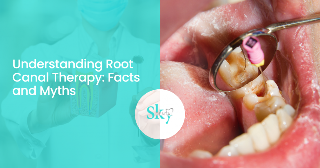 Understanding Root Canal Therapy: Facts and Myths