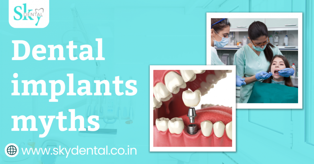 Dental implants myths