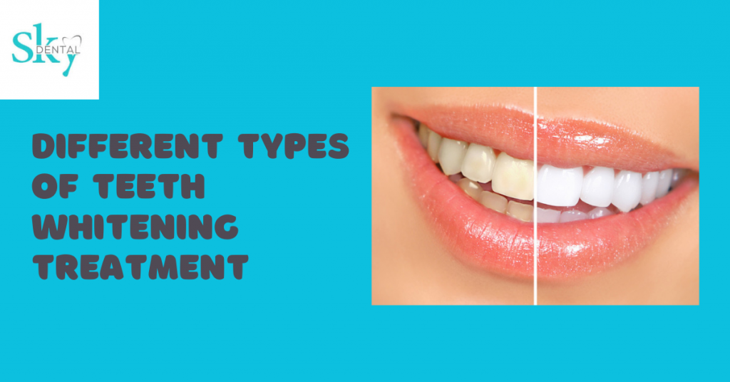 types of teeth whitening